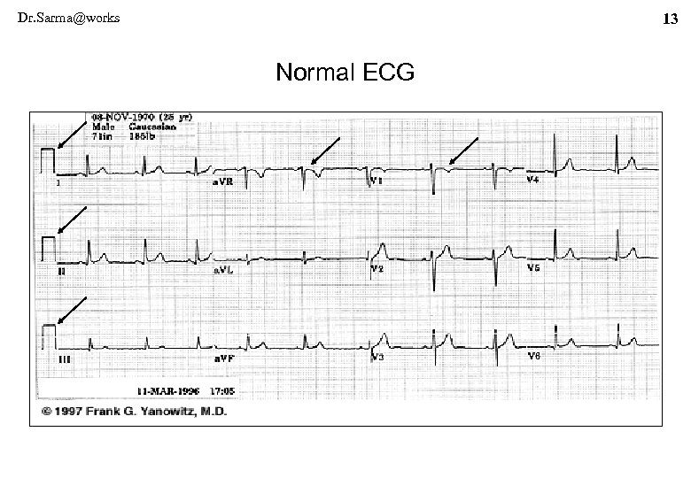 Dr. Sarma@works 13 Normal ECG 