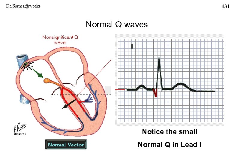 Dr. Sarma@works 131 Normal Q waves Notice the small Normal Q in Lead I