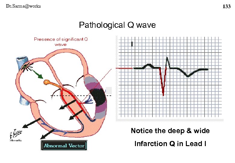 Dr. Sarma@works 133 Pathological Q wave Notice the deep & wide Infarction Q in