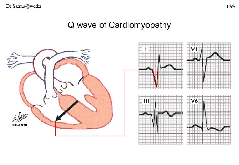 Dr. Sarma@works 135 Q wave of Cardiomyopathy 