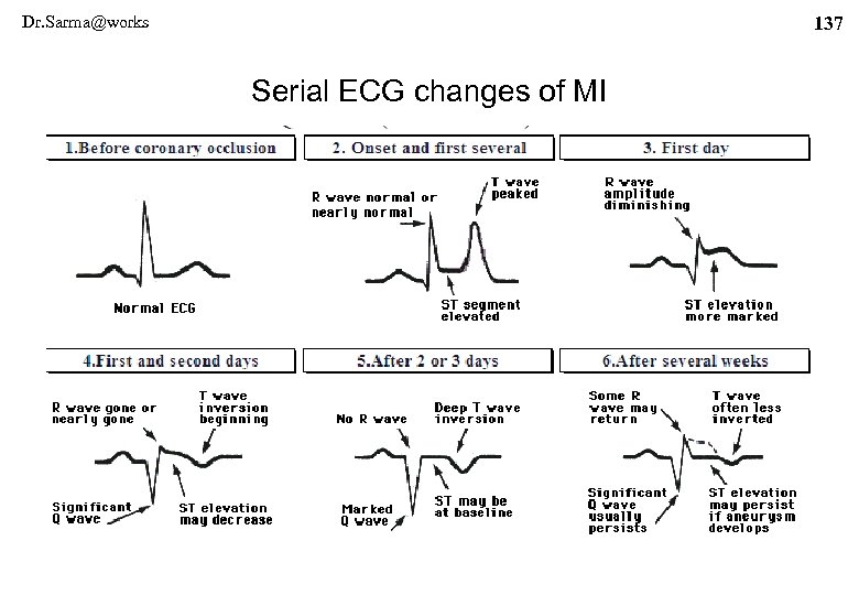 Dr. Sarma@works 137 Serial ECG changes of MI 