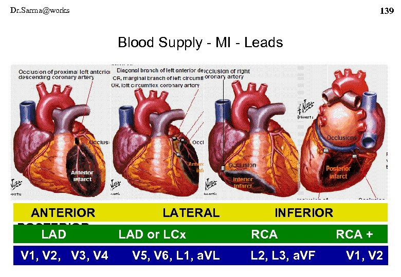 Dr. Sarma@works 139 Blood Supply - MI - Leads ANTERIOR LATERAL POSTERIOR LAD or