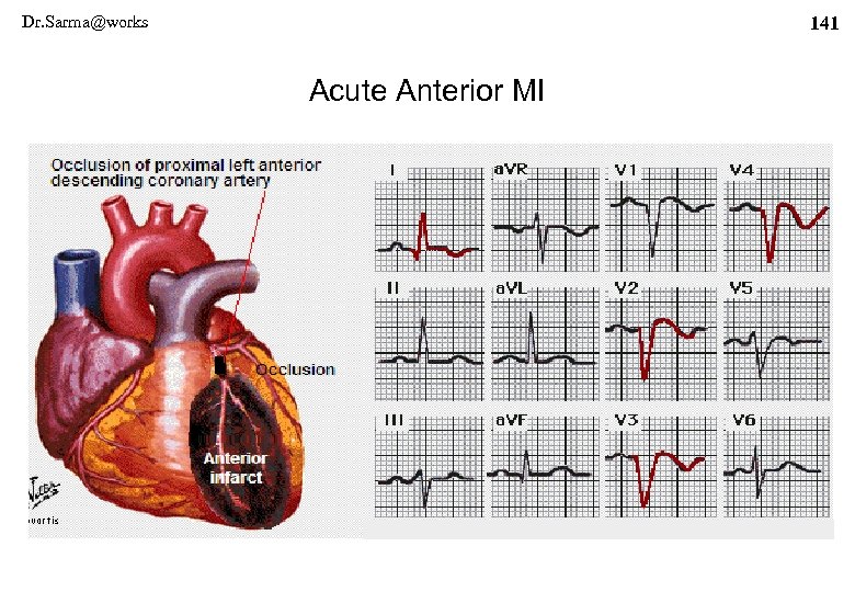Dr. Sarma@works 141 Acute Anterior MI 