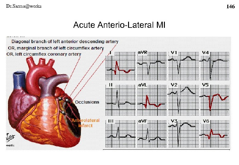 Dr. Sarma@works 146 Acute Anterio-Lateral MI 
