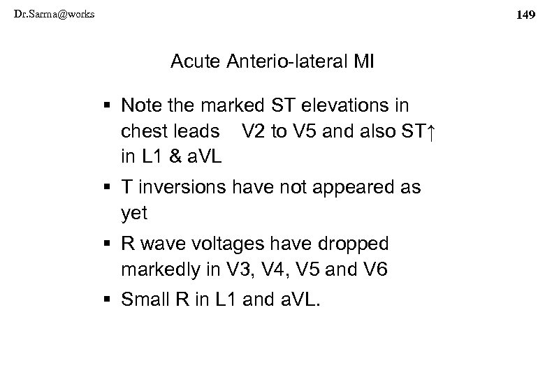 Dr. Sarma@works 149 Acute Anterio-lateral MI § Note the marked ST elevations in chest