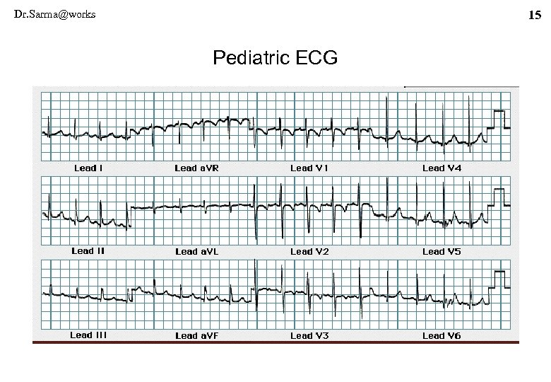 Dr. Sarma@works 15 Pediatric ECG 