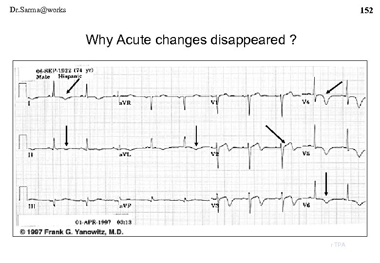 Dr. Sarma@works 152 Why Acute changes disappeared ? r TPA 