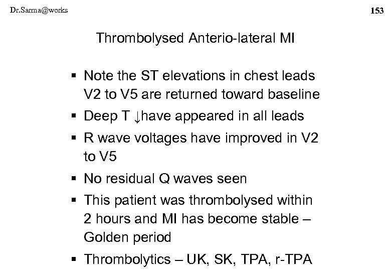 Dr. Sarma@works 153 Thrombolysed Anterio-lateral MI § Note the ST elevations in chest leads