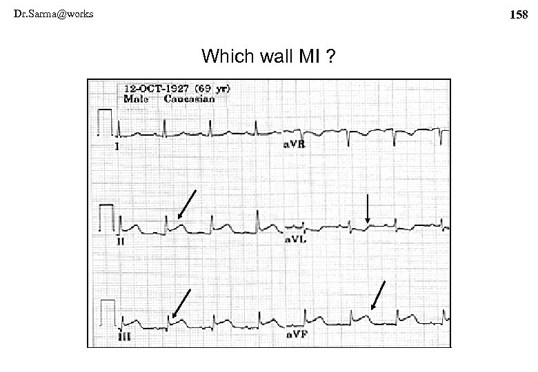 Dr. Sarma@works 158 Which wall MI ? 