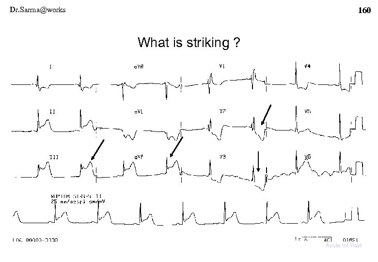 Dr. Sarma@works 160 What is striking ? Acute Inf Post 
