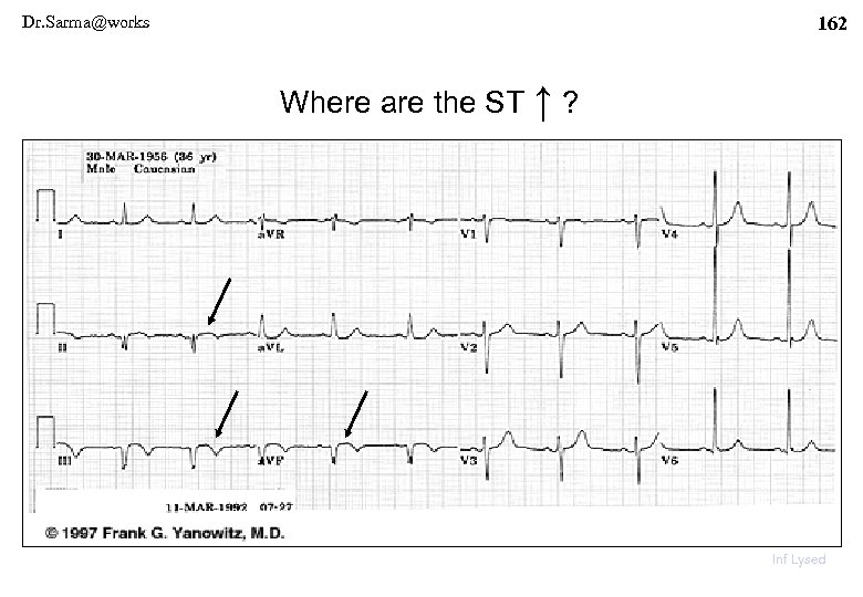Dr. Sarma@works 162 Where are the ST ↑ ? Inf Lysed 