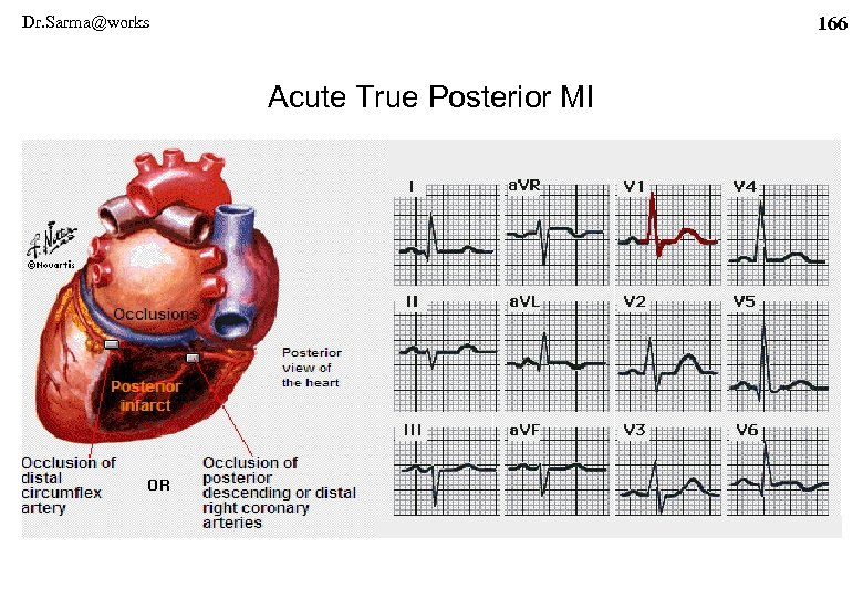 Dr. Sarma@works 166 Acute True Posterior MI 