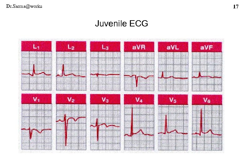 Dr. Sarma@works 17 Juvenile ECG 