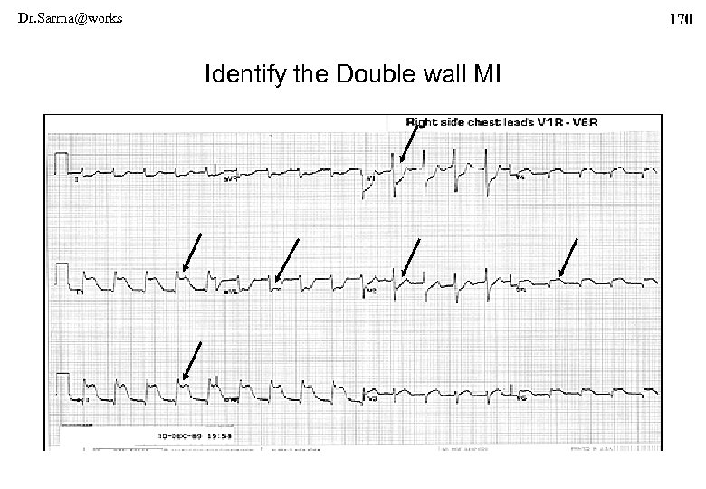 Dr. Sarma@works 170 Identify the Double wall MI 