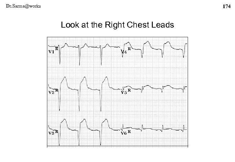 Dr. Sarma@works 174 Look at the Right Chest Leads R R R 
