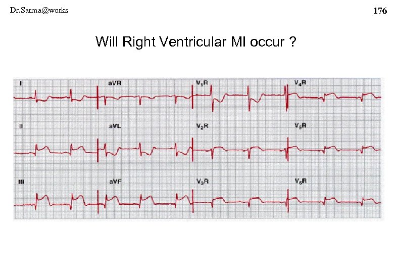 Dr. Sarma@works 176 Will Right Ventricular MI occur ? 