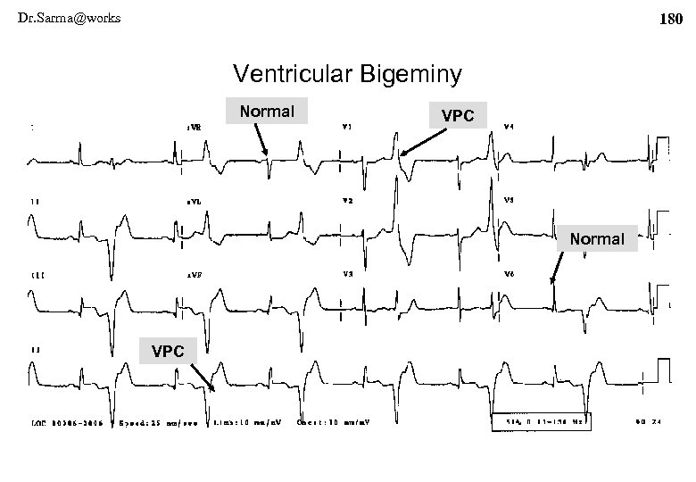 Dr. Sarma@works 180 Ventricular Bigeminy Normal VPC 