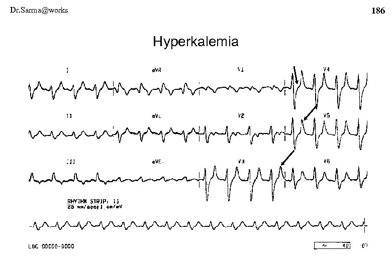 Dr. Sarma@works 186 Hyperkalemia 