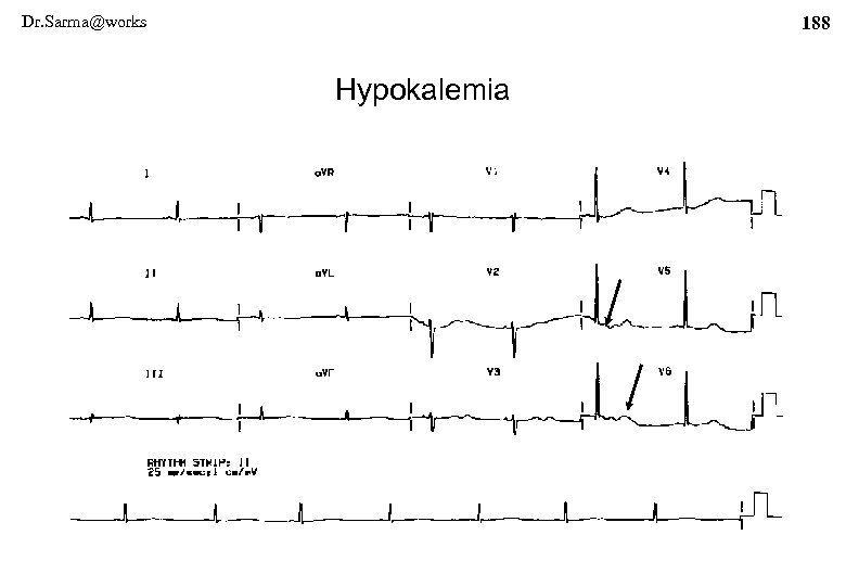 Dr. Sarma@works 188 Hypokalemia 
