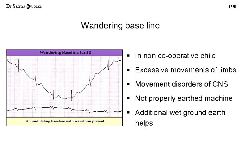 Dr. Sarma@works 190 Wandering base line § In non co-operative child § Excessive movements