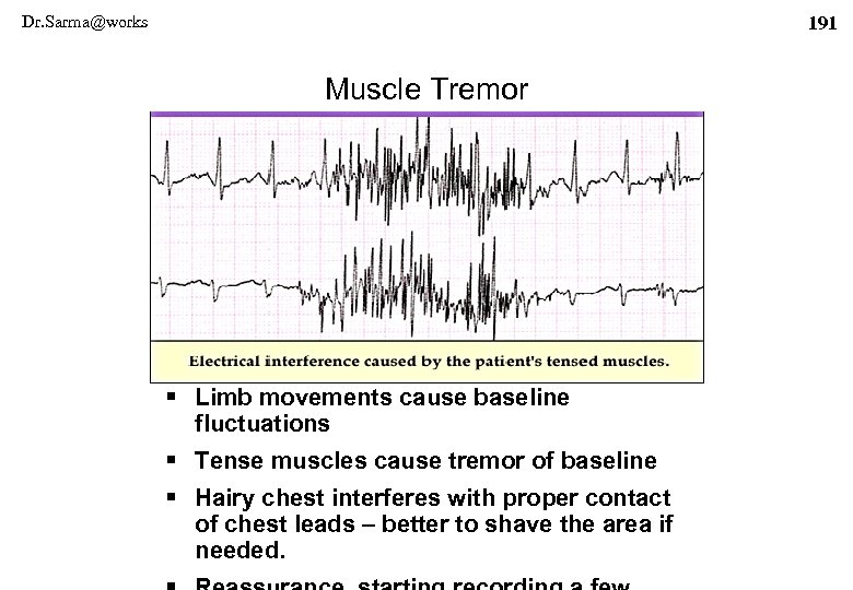 Dr. Sarma@works 191 Muscle Tremor § Limb movements cause baseline fluctuations § Tense muscles