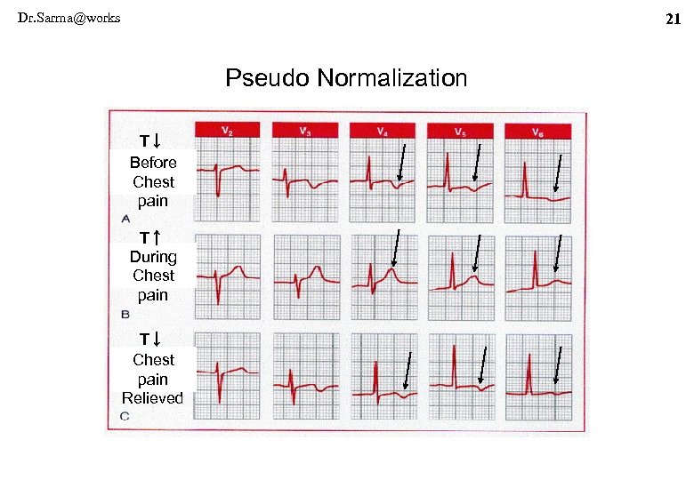Dr. Sarma@works 21 Pseudo Normalization T↓ Before Chest pain T↑ During Chest pain T↓