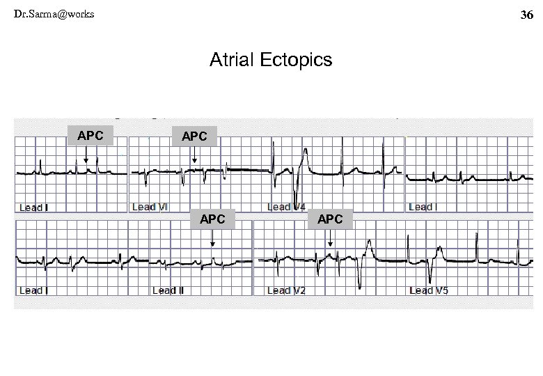 Dr. Sarma@works 36 Atrial Ectopics APC APC 