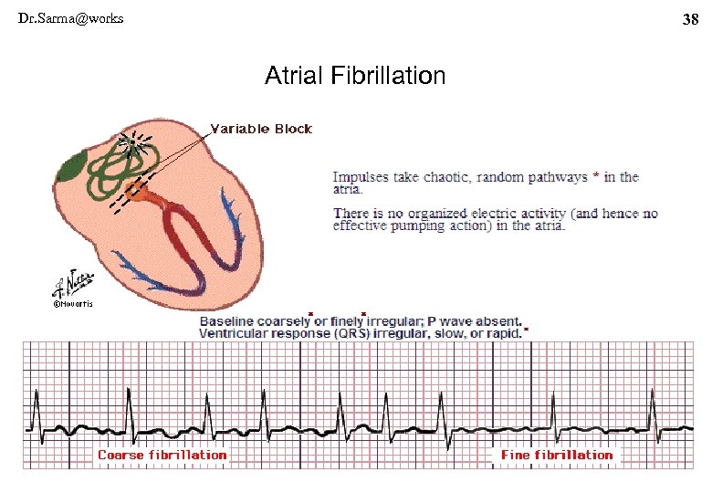 Dr. Sarma@works 38 Atrial Fibrillation 