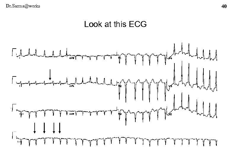 Dr. Sarma@works 40 Look at this ECG 