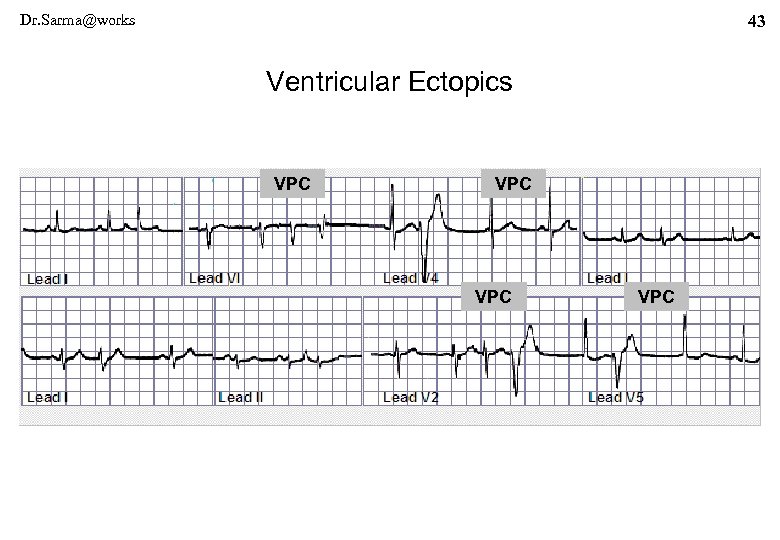 Dr. Sarma@works 43 Ventricular Ectopics VPC VPC 
