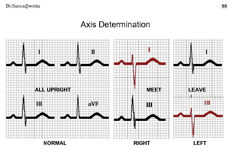 Dr. Sarma@works 55 Axis Determination ALL UPRIGHT NORMAL MEET RIGHT LEAVE LEFT 