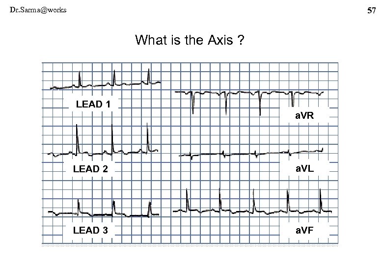 Dr. Sarma@works 57 What is the Axis ? LEAD 1 a. VR LEAD 2