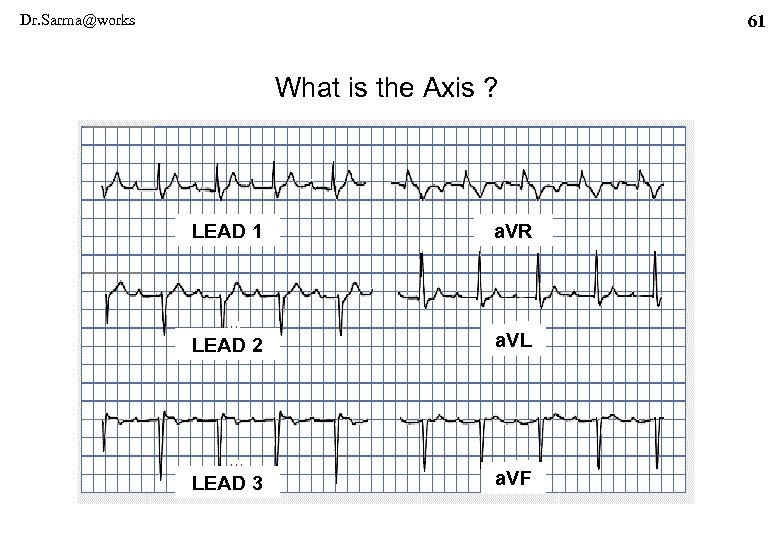 Dr. Sarma@works 61 What is the Axis ? LEAD 1 a. VR LEAD 2