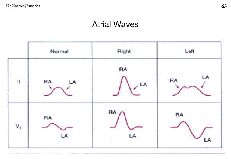 Dr. Sarma@works 63 Atrial Waves 