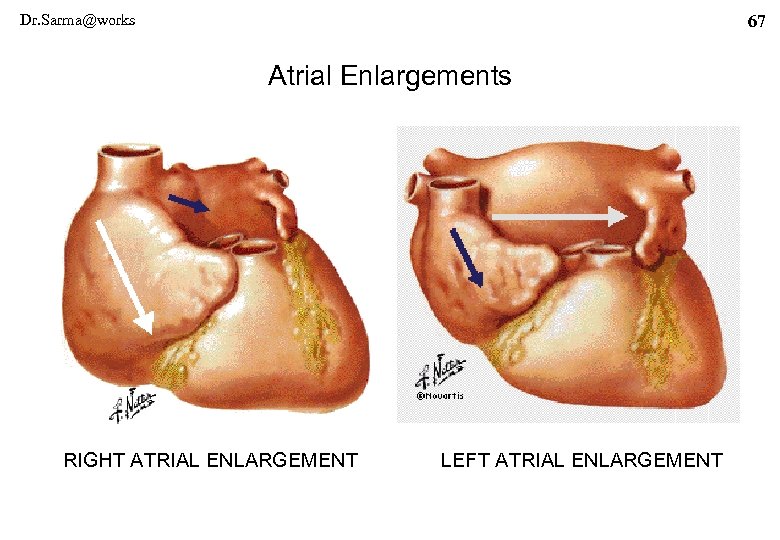 Dr. Sarma@works 67 Atrial Enlargements RIGHT ATRIAL ENLARGEMENT LEFT ATRIAL ENLARGEMENT 