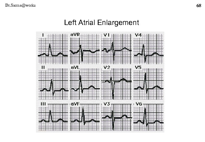 Dr. Sarma@works 68 Left Atrial Enlargement 