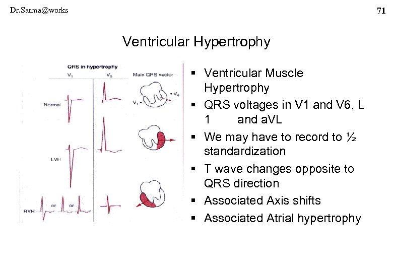 Dr. Sarma@works 71 Ventricular Hypertrophy § Ventricular Muscle Hypertrophy § QRS voltages in V