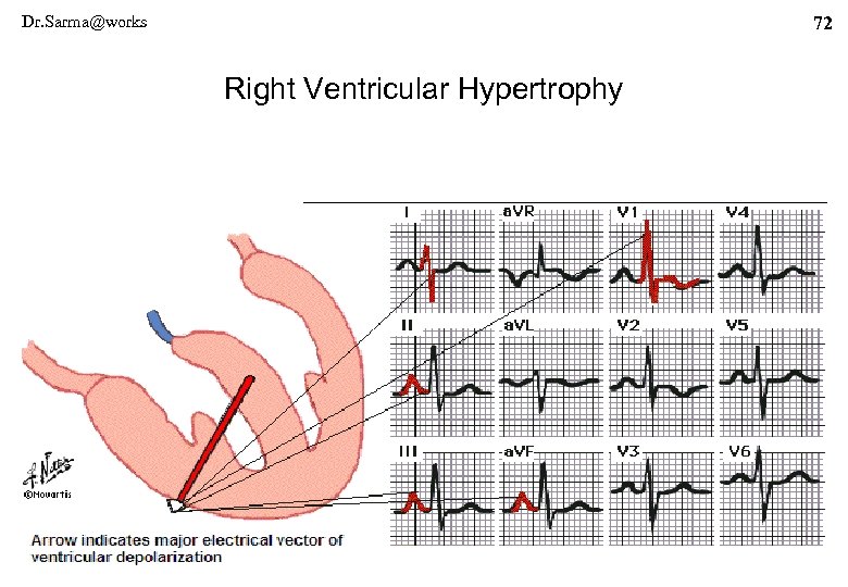 Dr. Sarma@works 72 Right Ventricular Hypertrophy 