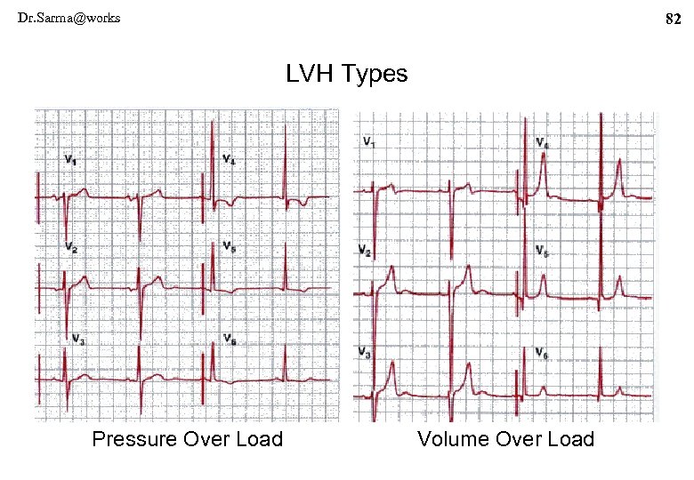 Dr. Sarma@works 82 LVH Types Pressure Over Load Volume Over Load 