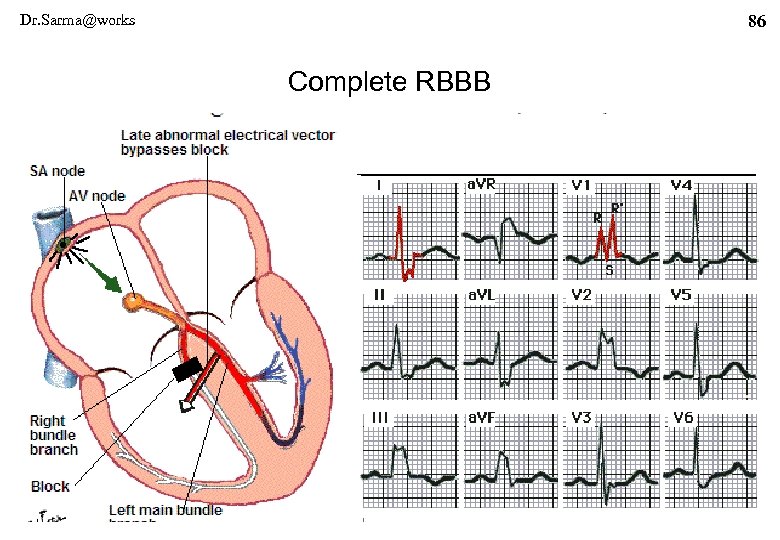 Dr. Sarma@works 86 Complete RBBB 