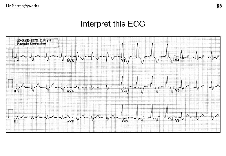 Dr. Sarma@works 88 Interpret this ECG 