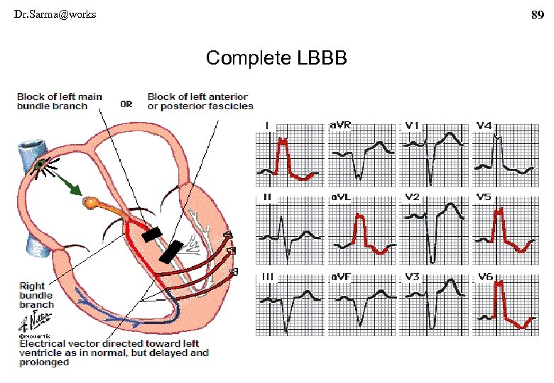Dr. Sarma@works 89 Complete LBBB 