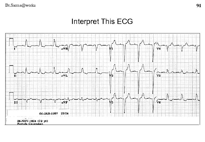 Dr. Sarma@works 91 Interpret This ECG 