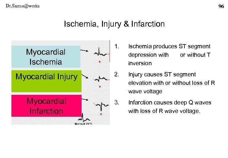 Dr. Sarma@works 96 Ischemia, Injury & Infarction 1. Ischemia produces ST segment depression with