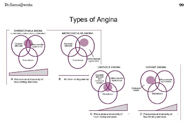 Dr. Sarma@works 99 Types of Angina CHRONIC STABLE ANGINA 