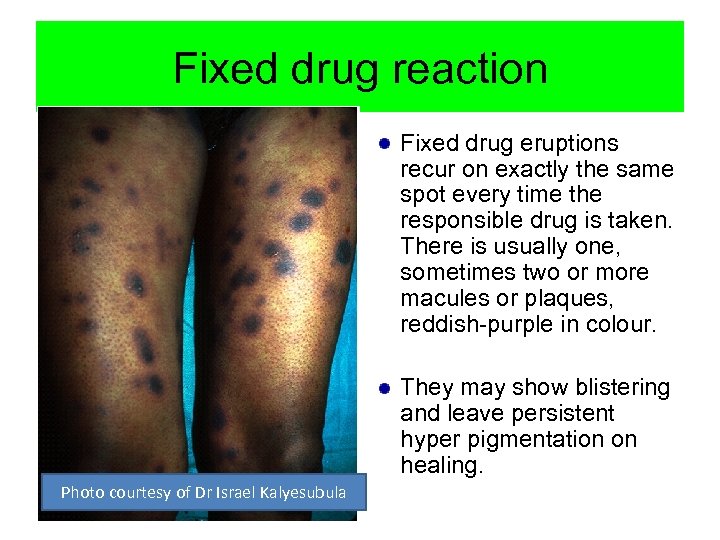 Fixed drug reaction Fixed drug eruptions recur on exactly the same spot every time