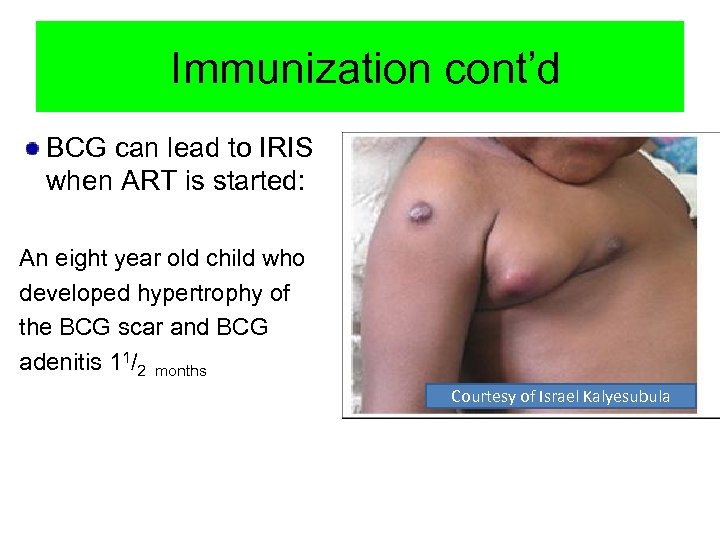 Immunization cont’d BCG can lead to IRIS when ART is started: An eight year