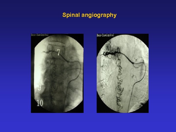Spinal angiography 