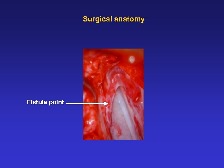 Surgical anatomy Fistula point 