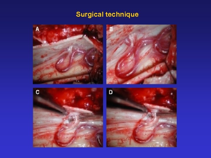Surgical technique 